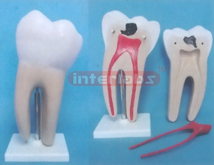 GIANT CARIES MOLAR, (3 PCS / SET)